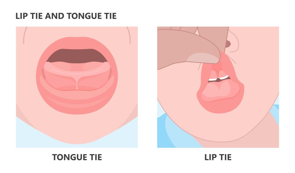 infant frenectomy edmonton