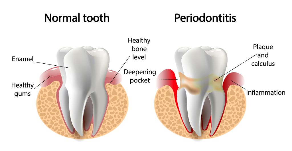 periodontal treatment edmonton