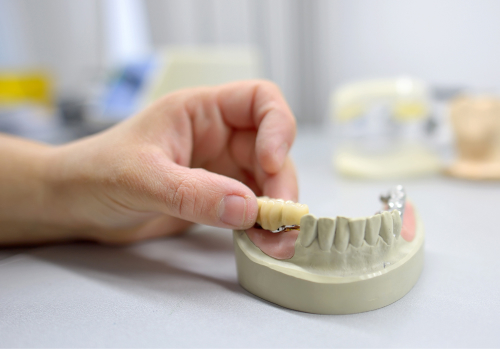 dental bridges edmonton