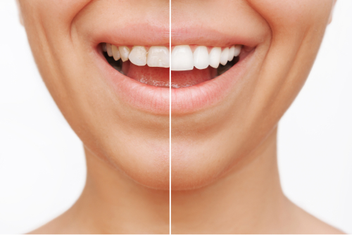 dental veneers edmonton