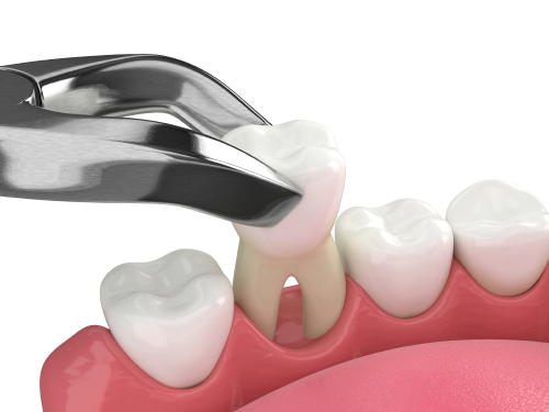 tooth extractions edmonton