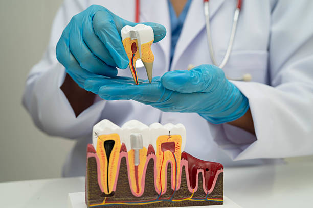 why choose root canal therapy over tooth removal